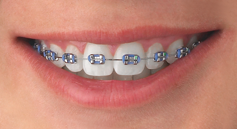metal bracket braces